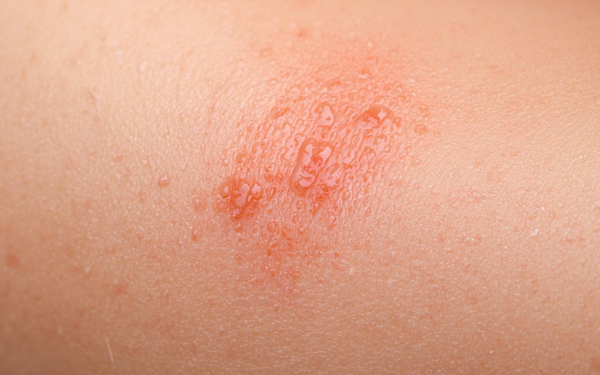 Dermatitis del pañal
